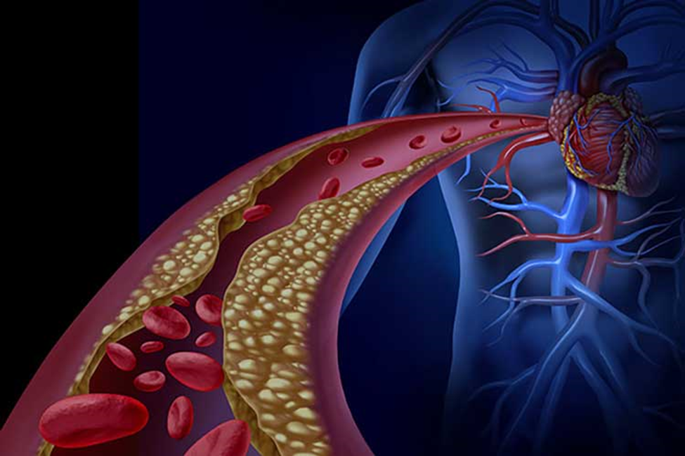 بیماری قلبی