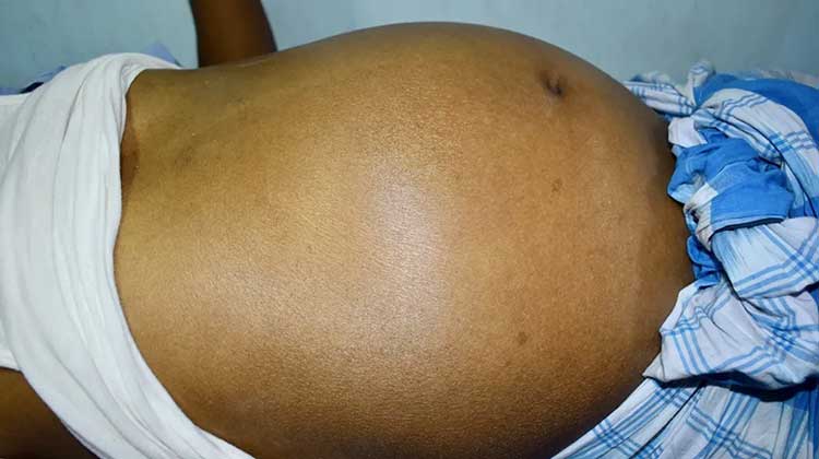 آب آوردن شکم