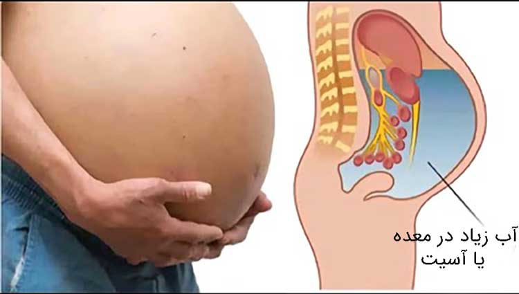 آب آوردن شکم