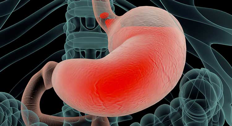 آب آوردن شکم