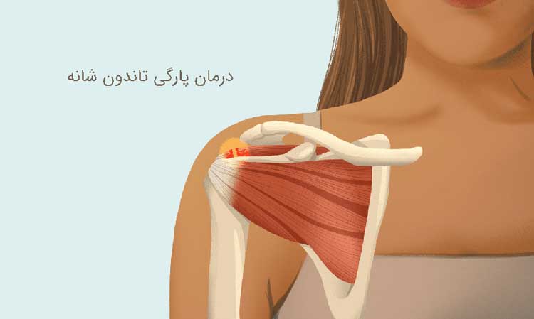 درمان پارگی تاندون شانه